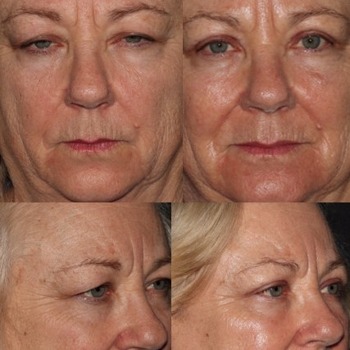 Bilateral Upper Blepharoplasty and Full Face CO2 Laser Skin Resurfacing