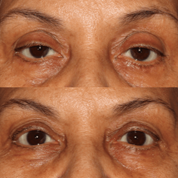 Ptosis Repair