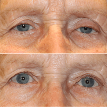 Ptosis Repair