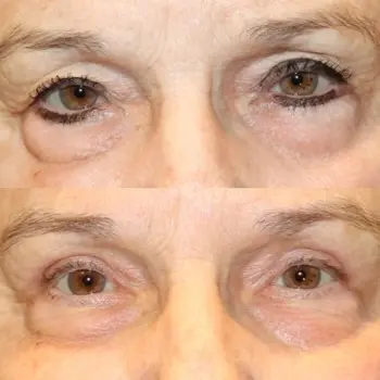 Upper Eyelid Blepharoplasty and Ptosis Repair
