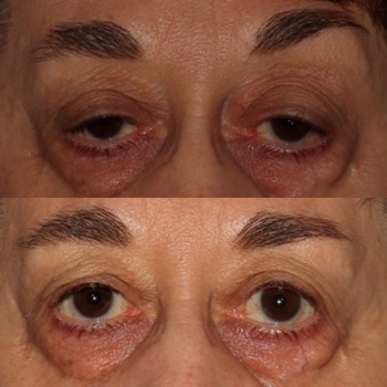 Ptosis Repair