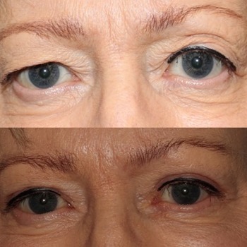 Upper Eyelid Blepharoplasty