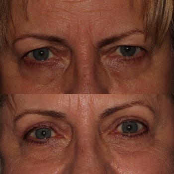 Upper Eyelid Blepharoplasty