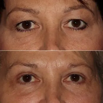 Upper and Lower Eyelid Blepharoplasty with Periorbital CO2 laser