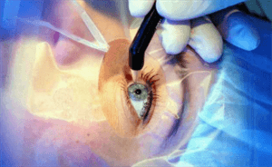 person receiving LASIK surgery 