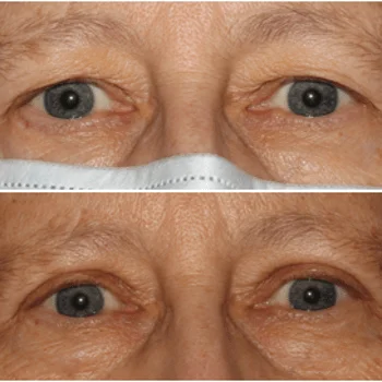 Upper Blepharoplasty