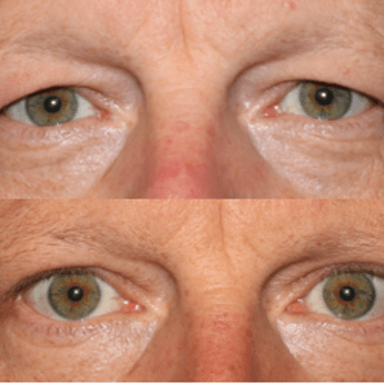 Upper Blepharoplasty