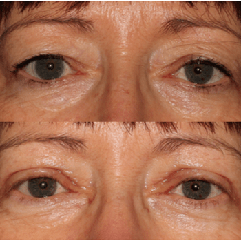 Upper Blepharoplasty