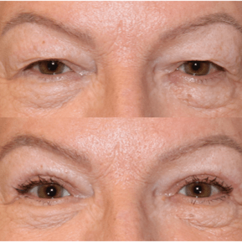Upper Blepharoplasty