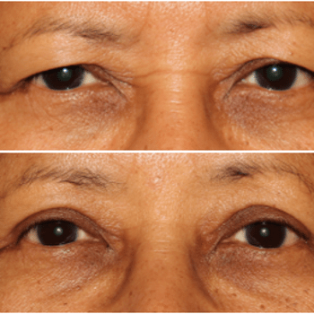Upper Blepharoplasty