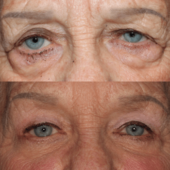 Upper Blepharoplasty and Ptosis Repair
