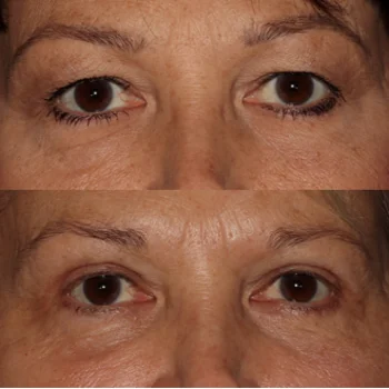 Upper and Lower Blepharoplasty