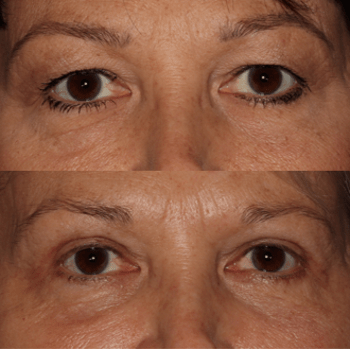 Upper Blepharoplasty and Ptosis Repair