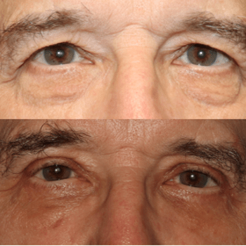 Upper and Lower Blepharoplasty