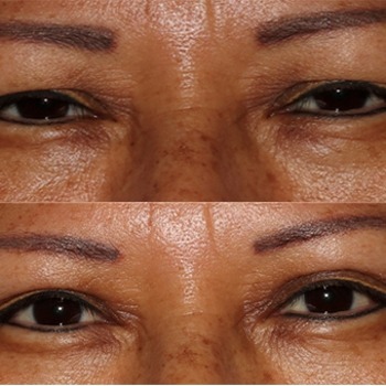 Ptosis Repair