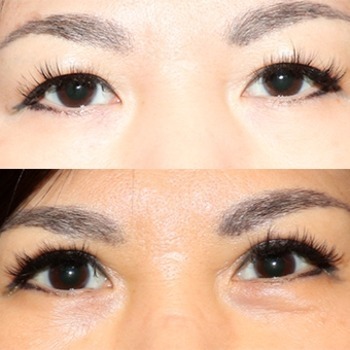 Upper Eyelid Blepharoplasty
