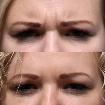 Botox for forehead, crows feet and between brows