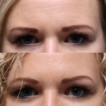Botox for forehead, crows feet and between brows