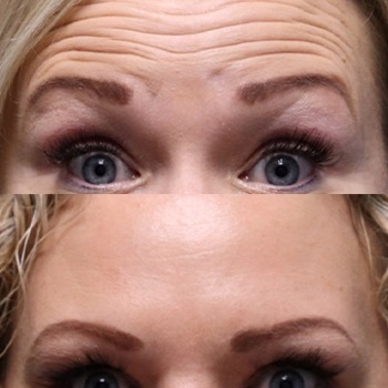 Botox for forehead, crows feet and between brows