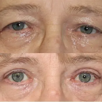 Upper Eyelid Blepharoplasty