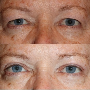 Upper Eyelid Blepharoplasty