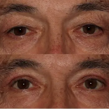 Upper Eyelid Blepharoplasty